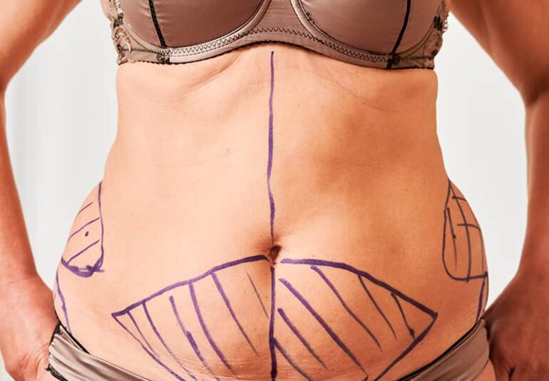 cicatrices en abdominoplastia